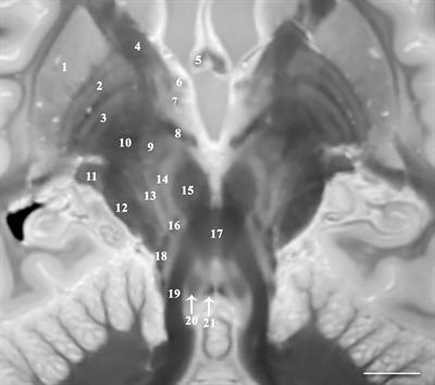 Inner SPACE: 400-Micron Isotropic Resolution MRI of the Human Brain